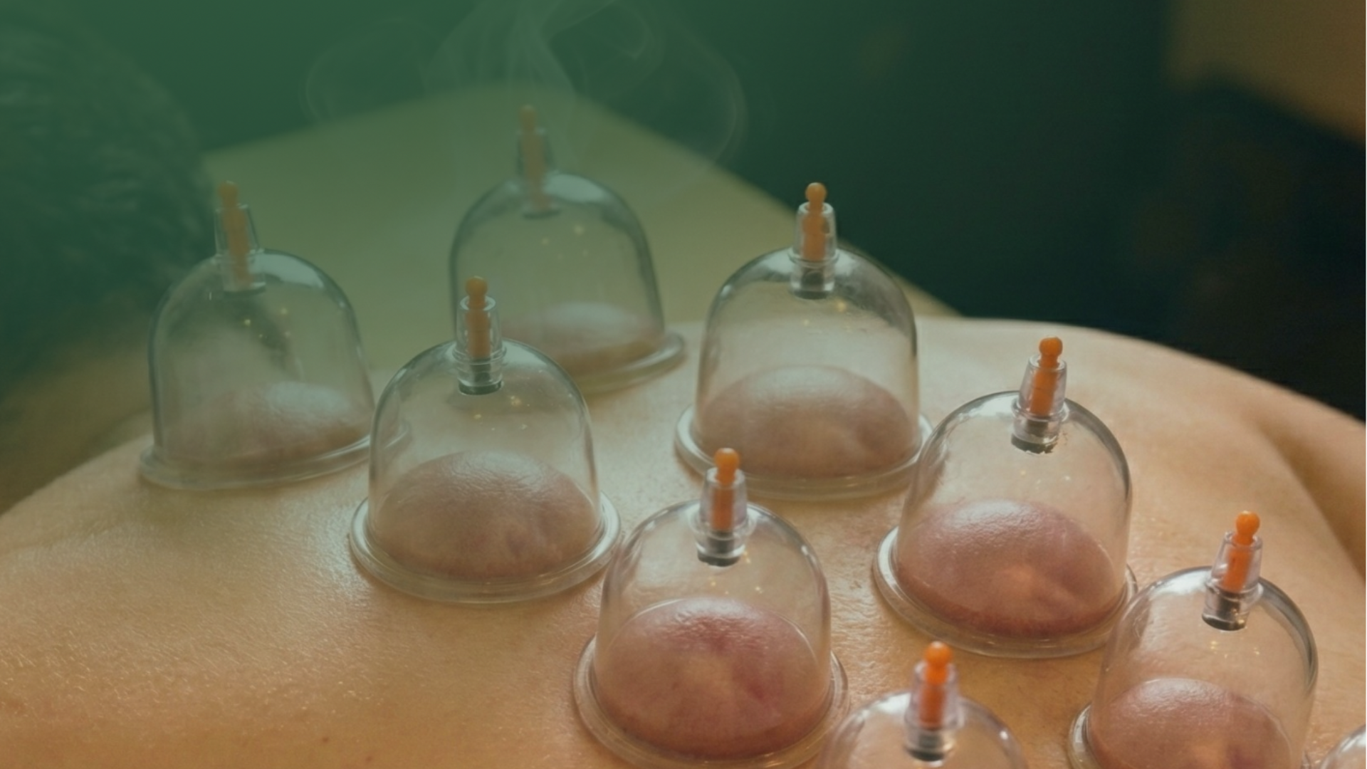 الحجامة العلاجية